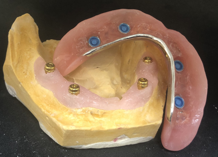 Implantes dentales en Córdoba - Rosario Serrano